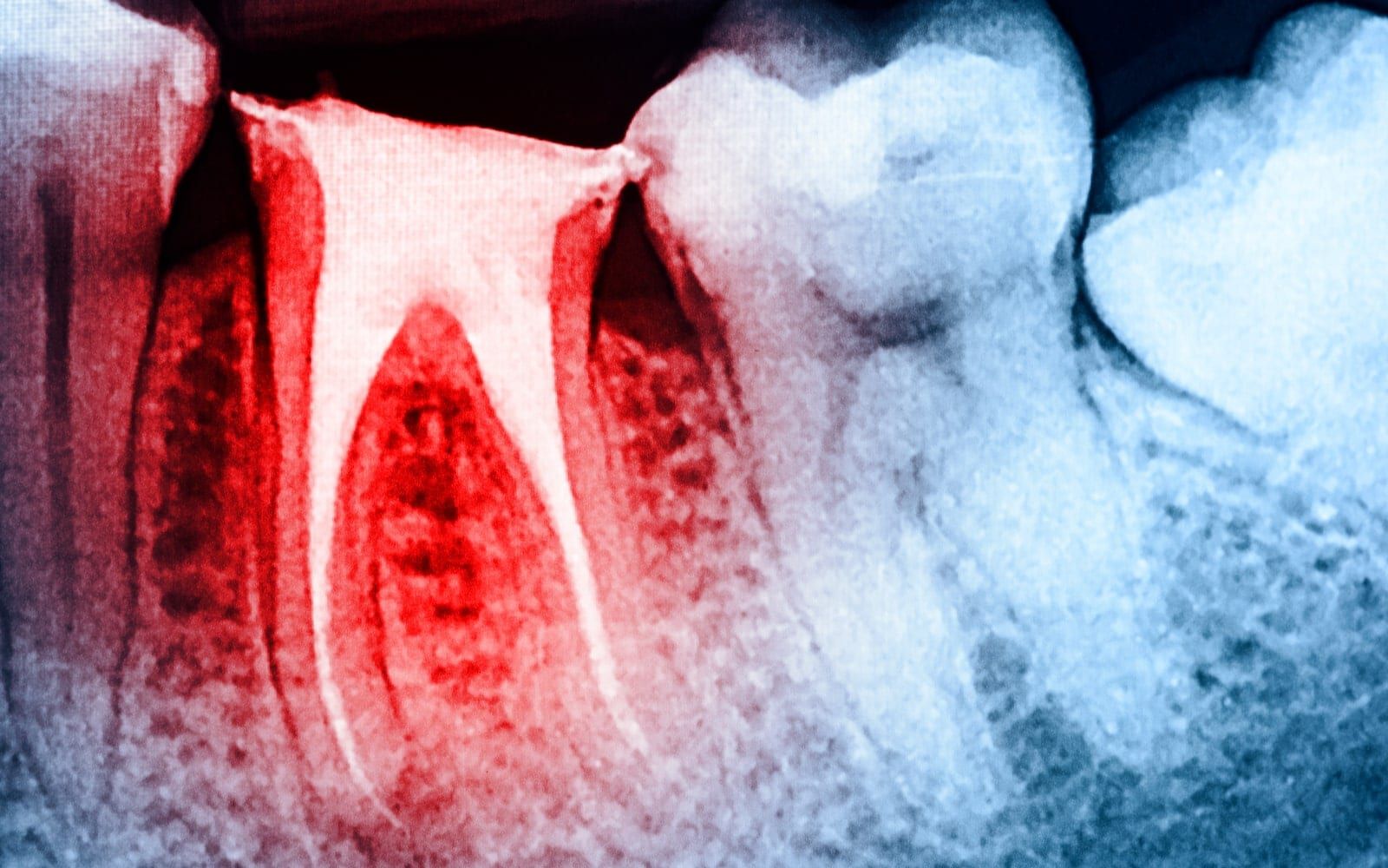 Root Canal Rendering