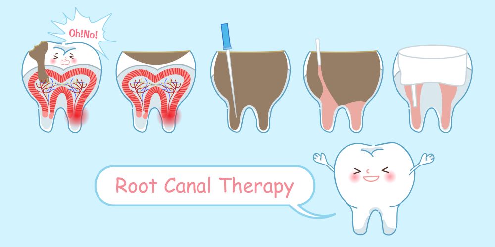 illustration of stages from healthy tooth to decay root canal and treatment