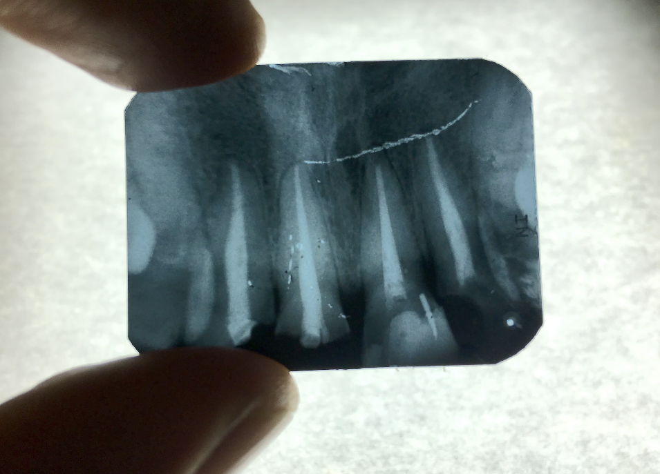 X-ray of old root canals