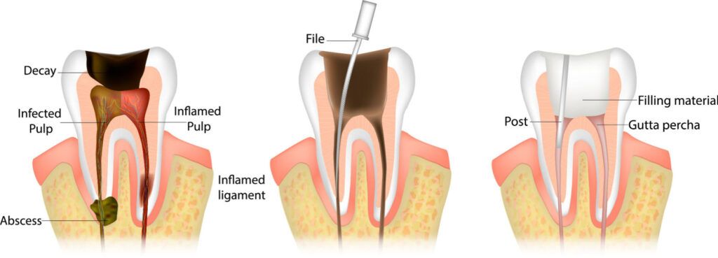 root canal steps illustration